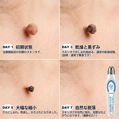 国内品質基準の製造施設 7日間でスキンタグ・シミをケア 痛みが少なく、跡が残りにくい先進ロールオンペン
